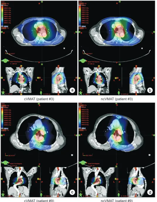 Fig. 3. For representative patient cases (patient #3 and #9), calculated dose distributions in the axial, coronal, and sagittal views of coplanar  volumetric modulated arc therapy (cVMAT) plans (a) and noncoplanar VMAT (ncVMAT) plans (b) of patient #3, and