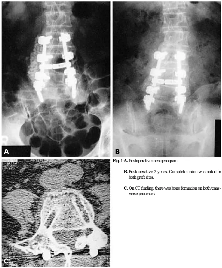 Fig. 1-A. Postoperative roentgenogram