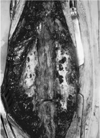 Fig. 3. Showing multiple pores in CS mixed with AGB site(Rt) as compared with autogenous graft(Lt) on gross findings.