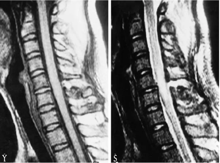 Fig. 1. Spinal cord edema; 35-year-old woman presenting Frankel grade D; MRI was performed 5 days from injury.