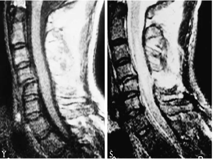 Fig. 2. Spinal cord swelling; 44-year-old man presenting Franke B; MRI was performed at 2 days from injury.