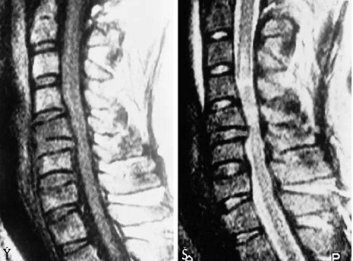 Fig. 3. Spinal cord contusion. 25-year-old man presenting Frankel B; MRI was performed 2 days from injury.