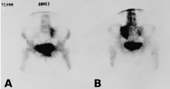 Fig. 2. Technetium 99m bone scan revealing increased uptake in the left sacral ala.
