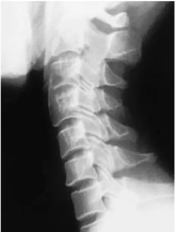 Fig. 5. Postoperative 3 year lateral radiograph shows solid bone union between C3-4 vertebral body.