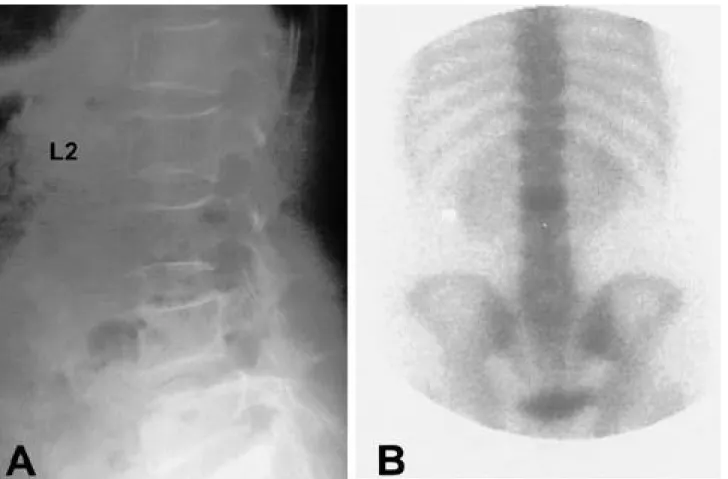 Fig. 1-A. The lateral radiography demonstrated compression fracture at the L2 level. 
