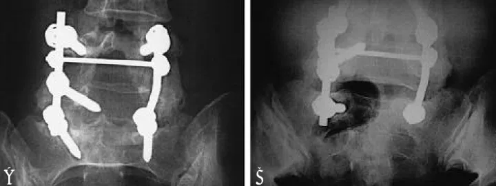 Fig. 1. A 40-year-old woman with spinal stenosis from L4 to S1 not responding to conservative treatment underwent decompression and bilateral instrumented posterolateral fusion from L4 to sacrum 12 months ago