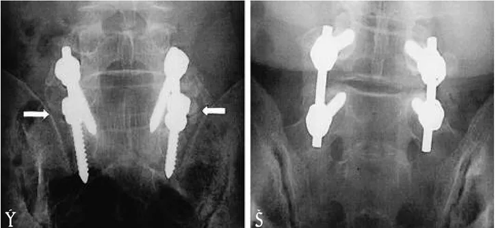 Fig. 2-A. The cortical bones of the transverse processes and sacral ala can be misdiagnosed as the cracks(pseudarthroses)(white arrows)