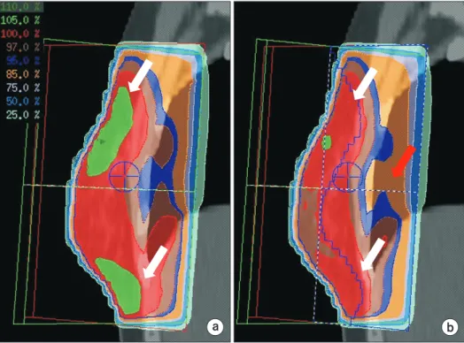Fig. 3. Comparison of dose distribu- distribu-tion (sagittal view) between the  appli ca tion of (a) a conventional  tan-gen tial field and (b) a conventional  field-in-field (FIF) boost technique