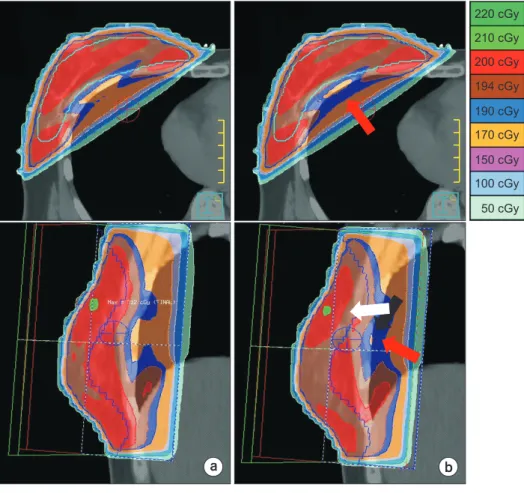 Fig. 4. Comparison of dose distribu- distribu-tion between (a) static FIF (SFIF) and  (b) dynamic FIF (DFIF)