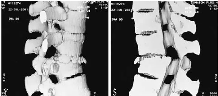 Fig. 4. ‘Jigsaw puzzle’ sign in compression fracture.