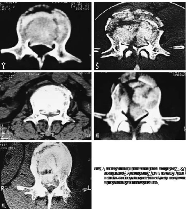 Fig. 5. Several patterns of retropulsed fragments in the CT.  A . single central. B. sagittal split