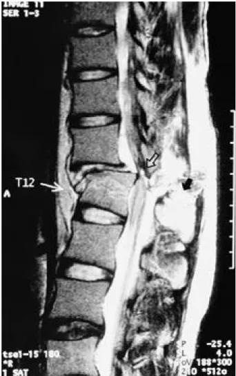 Fig. 8. MR is superior to any other imaging modalities in eval- eval-uation of the posterior ligament complex injury(black arrow)
