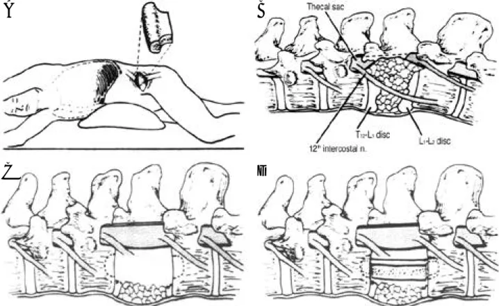 Fig. 1-A. The retroperitoneal approach to the first lumbar vertebra from the left through an incision overlying the twelfth rib.