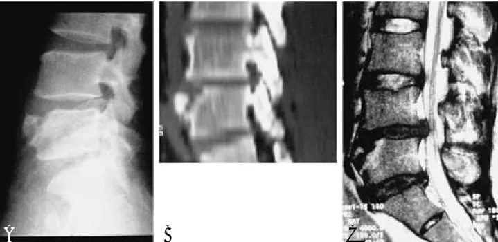 Fig. 1-B. CT sagittal reformat view. The bony defect at the anterior edge of the vertebral body with irregular and increased density was seen.