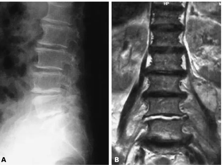 Fig. 1-A. Initial lateral radiographs shows mild narrowing of L4-5 disc space and subchondral sclerosis adjacent to the end plates.