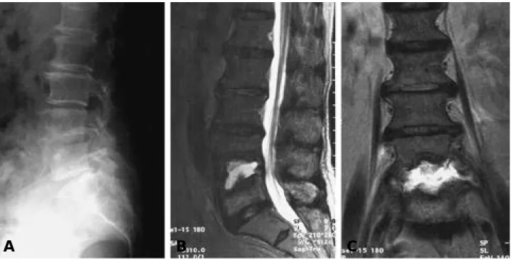 Fig. 2-A. Lateral X-ray at 7 weeks post-PCD shows progression of bony destruction.