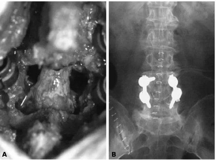 Fig. 3-A. After thorough curettage of intervertebral dead space and copious irrigation, transpedicular screws were inserted.