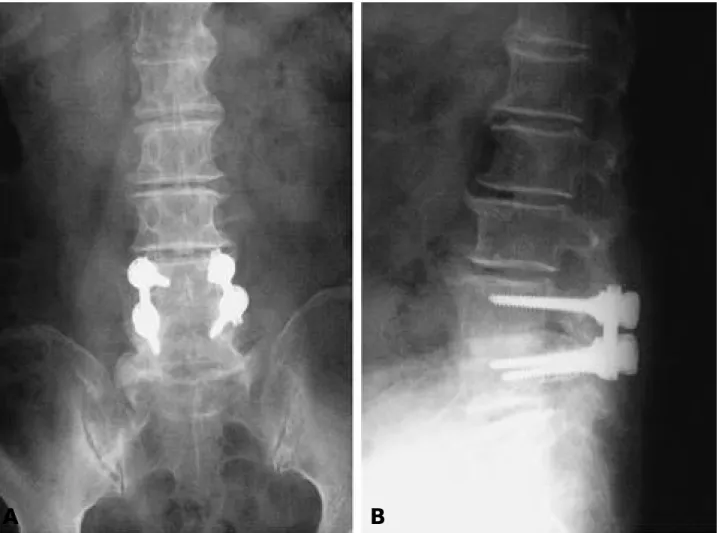 Fig. 4-A. Complete solid fusion at postoperative 1 year.