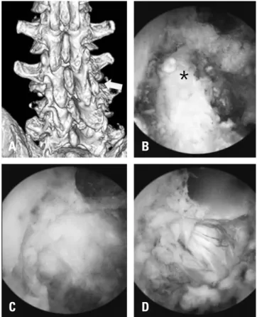 Fig. 4. Unilateral biportal endoscopy was performed. (A) Three-dimen- Three-dimen-sional computed tomography scan for preoperative planning, showing  the L3-4 right foraminal area (arrow)