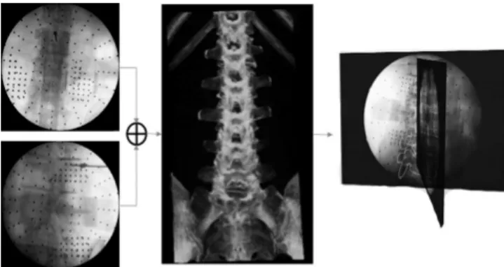 Fig. 6. (A) Schematic illustration of augmented reality (AR)-based spine  surgery. After attaching the AR marker (DRB) to the patient’s vertebrae,  and completing the computed tomography (CT)-fluoroscopy or  paired-point matching, the motion of the vertebr