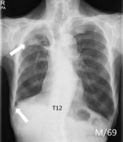 Fig. 2. A chest radiograph of a 69-year-old man revealed a focal nodular  opacity in the right upper lobe and right costophrenic angle blunting