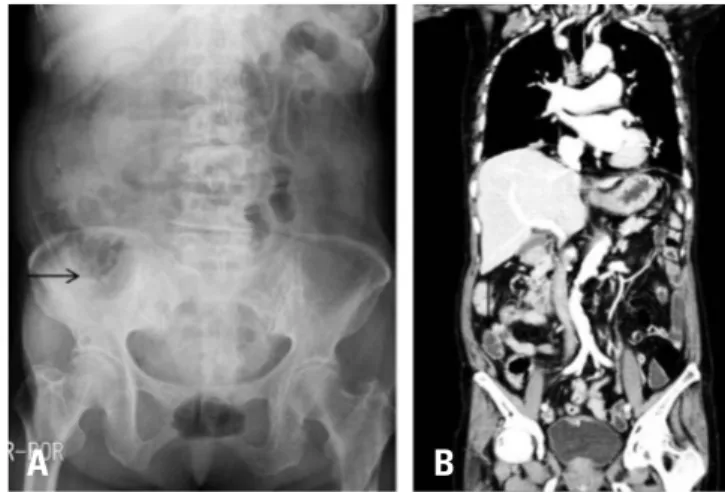 Fig. 4. (A, B) An abdominal radiograph and computed tomography scan  taken on postoperative day 6, at 12 hours after neostigmine  administra-tion, demonstrating a dramatic reduction in colonic air and fecal  impac-tion.