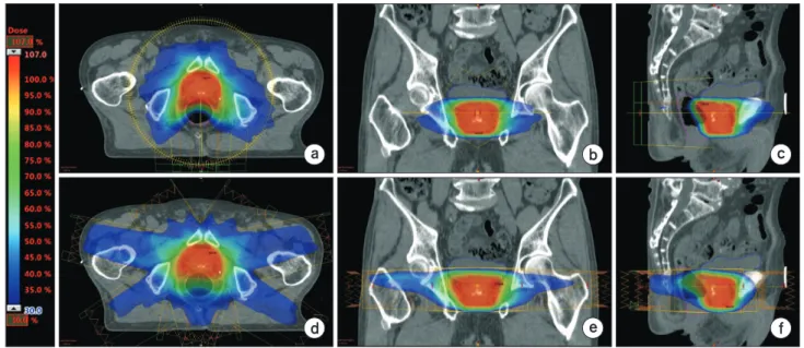 Fig. 3. A representative patient’s dose distributions for the prostate case is presented before (upper row) and after (lower row) dose  volume histogram based plan conversion