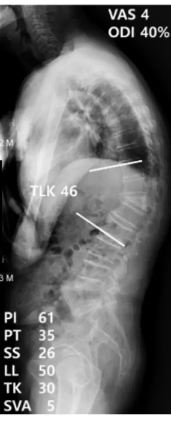 Fig. 2. Example of a post-osteoporotic vertebral compression fracture  thoracolumbar kyphosis patient with sagittal balance