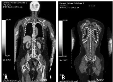 Fig. 2. Positron emission tomography computed tomography shows flude- flude-oxyglucose uptake in the T9 vertebra and right iliac bone.