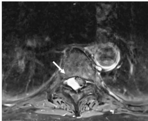 Fig. 1. Sagittal T1-weighted (T1W), T2-weighted (T2W), and T1 fat- fat-suppressed and gadolinium-containing contrast-enhanced magnetic  reso-nance imaging scan