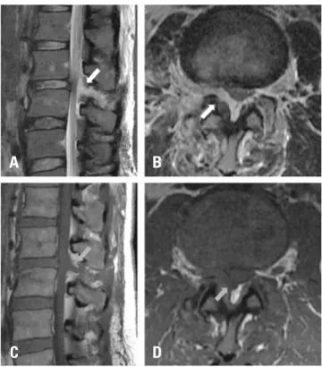 Fig. 1. Anteroposterior (A) and lateral (B) radiographs of the lumbar  spine at the initial assessment show a compression fracture of L3 (arrow)  and increased distance between the L2 and L3 spinous processes  (bidi-rectional arrow).