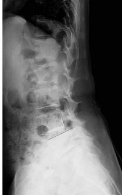 Fig. 1. Meyerding grading method showing grade II spondylolisthesis of  L4.