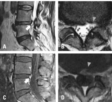 Fig. 1. Magnetic resonance imaging (MRI) findings. (A, B) T2-weighted  MRI images showing hyperintense signal changes in the annulus fibrosus  at the previous discectomy site (arrow, sagittal view; arrowhead, axial  view)