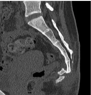 Fig. 4. (A, B) Postoperative radiographs show anatomically reduced coc- coc-cyx dislocation.
