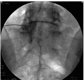 Fig. 2. Fluorography showing a procedure in which L5  nerve root block was performed selectively.