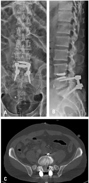Fig. 4. The tack is shown maintaining its position well in (A) a coronal  image and (B) a sagittal image obtained 3 days after the operation