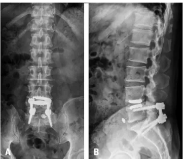 Fig. 5. (A) A coronal image and (B) a sagittal image obtained 1 year after  the operation show the tack maintaining its position well