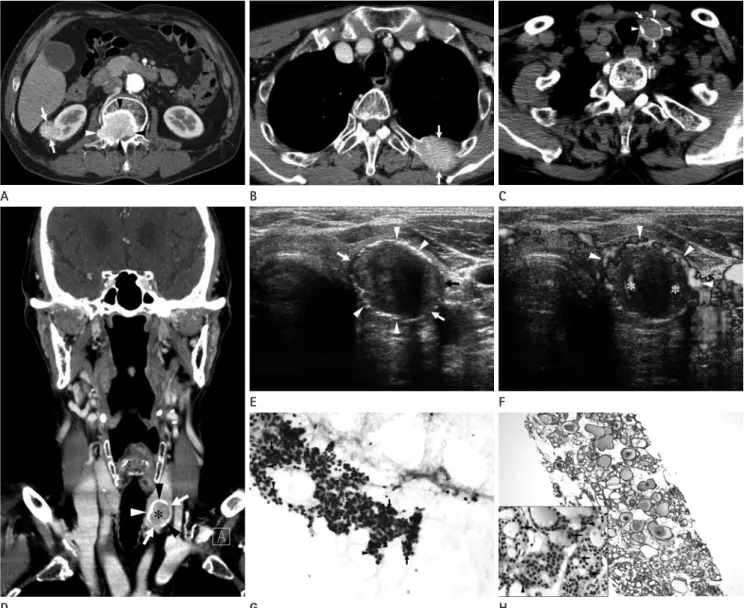 Fig. 1. CT and sonographic features of follicular thyroid carcinoma with interrupted eggshell calcification and metastatic lesions of the kidney  and bones in a 74-year-old man