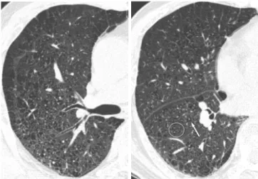 Fig.  4. High-resolution CT scan of 69-year-old man who previously  worked as coal miner for 15 years shows dilatation of the peripheral  bronchus (circle) and thickening of the bronchial wall (arrow).