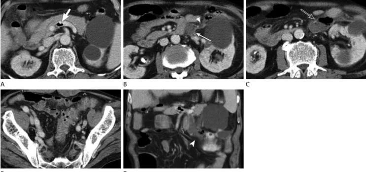 Fig. 1. A 72-year-old man with septic thrombophlebitis of the inferior mesenteric vein complicating sigmoid diverticulitis