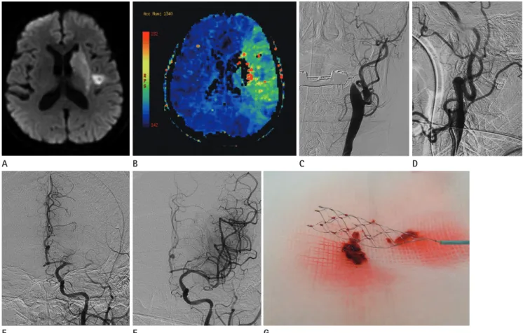 Fig. 1. Brain images from a 69-year-old man with acute ischemic stroke. His NIHSS score was 18 at admission