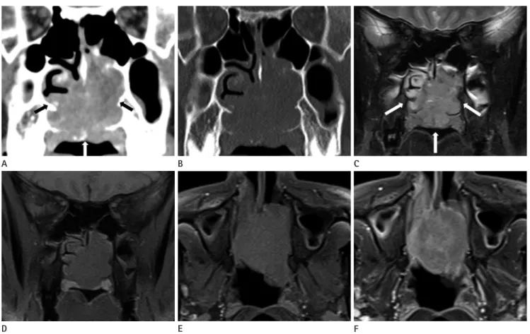 Fig. 2. Ewing’s sarcoma in the left nasal cavity in a 42-year-old man. Postcontrast coronal CT image (A) shows an expansile and well-defined  soft tissue mass (arrows) in the left nasal cavity with inhomogeneous enhancement