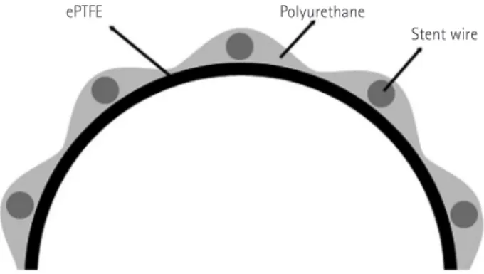 Fig. 2. The schematic cross section of the Niti-S® Covered Stent: the  outer polyurethane layer attaches the expanded  polytetrafluoroethyl-ene graft to the stent wires (0.007 in diameter).