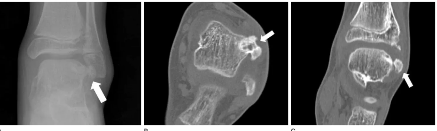 Fig. 4. 10-year-old man with Trevor’s disease in the left talus. Initial AP radiograph (A), unenhanced axial (B) and coronal (C) CT show irregular  ossified mass, arising talus, in the antero-lateral aspect of the talus (arrows).