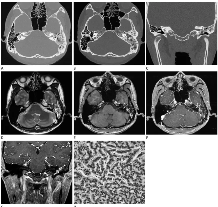 Fig. 1. CT, MRI, and pathologic features of middle ear adenoma of neuroendocrine differentiation in a 36-year-old man.