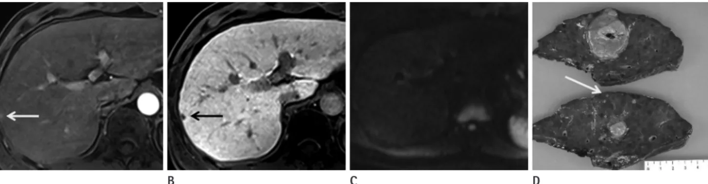 Fig. 2. Hepatocellular carcinoma in a 42-year-old man. The main mass, 4 cm sized expansile hypervascular tumor at S6, is not shown here