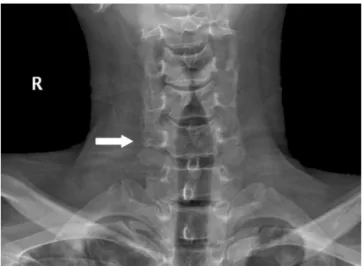 Fig.  2. Lateral view of the cervical spine. There is an anterior bony  projection between C5 and C6
