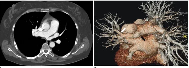 Fig. 1. Multislice CT axial image (A) and 3D volume rendering image (B) showing abnormal origin of a single stem of artery from posterior as- as-pect of the right pulmonary artery (black arrow)
