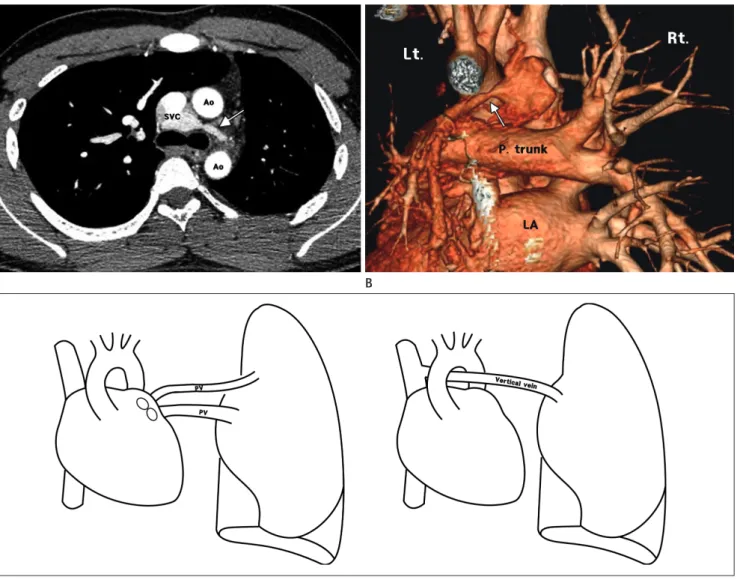 Fig. 1. Partial anomalous pulmonary venous return with atrophic subaortic vertical vein in 19-year-old man.