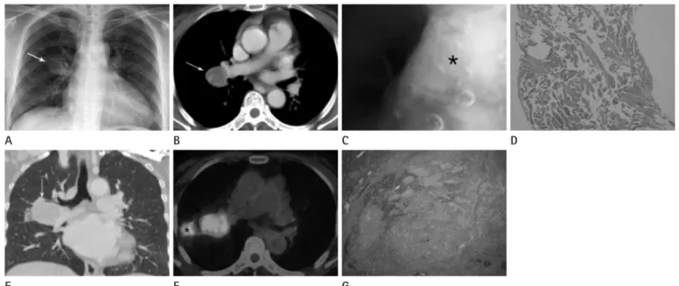 Fig. 1. Centrally located sclerosing hemangioma with endobronchial extension in a 58-year-old female